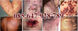 Illustration for article titled penyakit herpes kelamin pria